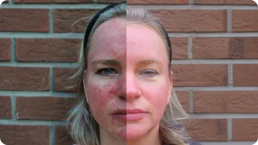 Imágenes del antes y después que muestran cambios en el enrojecimiento facial asociado a la rosácea.