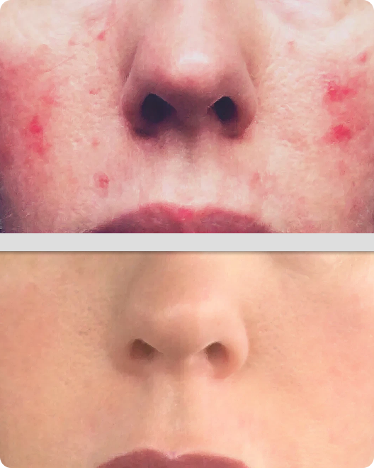 Imágenes del antes y después del acné y las imperfecciones